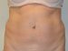 Tummy Tuck Before Patient Thumbnail 1