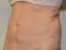 Tummy Tuck Before Patient Thumbnail 4