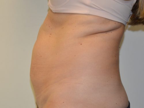 Tummy Tuck Before Patient 5