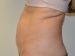 Tummy Tuck Before Patient Thumbnail 5