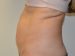 Tummy Tuck Before Patient Thumbnail 5