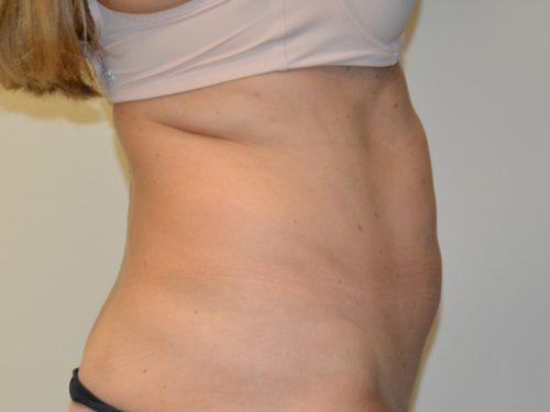 Tummy Tuck Before Patient 3