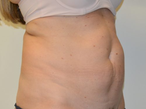 Tummy Tuck Before Patient 2