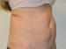 Tummy Tuck Before Patient Thumbnail 2