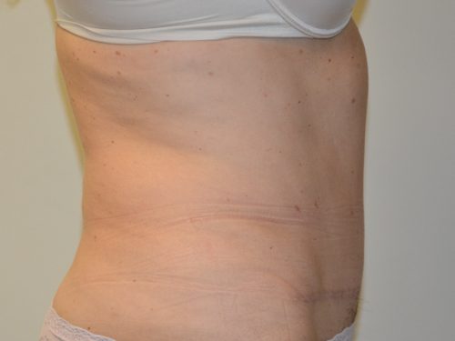 Tummy Tuck After Patient 3