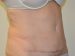 Tummy Tuck After Patient Thumbnail 2