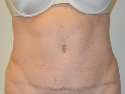 Tummy Tuck After Patient 1