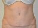 Tummy Tuck After Patient Thumbnail 1