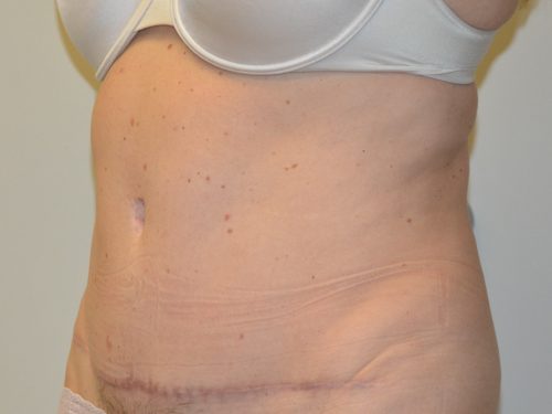 Tummy Tuck After Patient 4