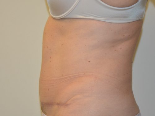 Tummy Tuck After Patient 5