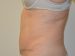 Tummy Tuck After Patient Thumbnail 5
