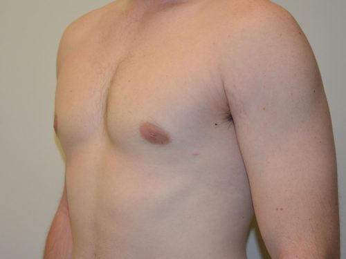 Male Breast Reduction After Patient 2