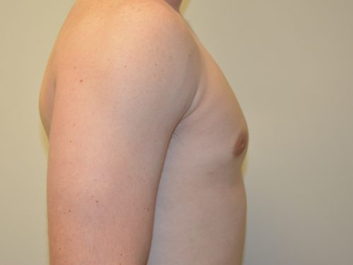 Male Breast Reduction After Patient 5