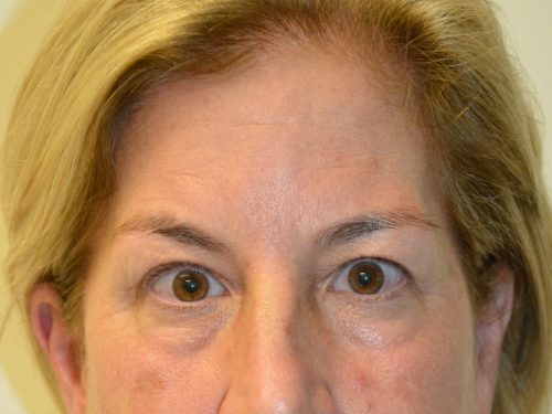 Eyelid Surgery Before Patient 1