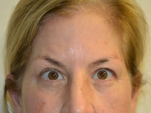 Eyelid Surgery After Patient 1