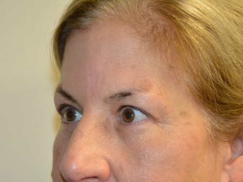 Eyelid Surgery After Patient 4