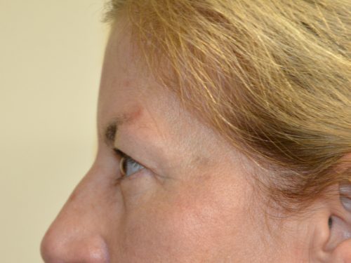 Eyelid Surgery After Patient 5