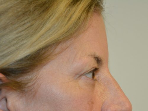 Eyelid Surgery After Patient 3