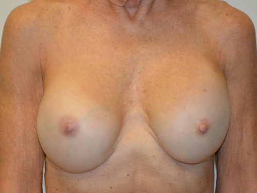 Breast Revision Before Patient 1