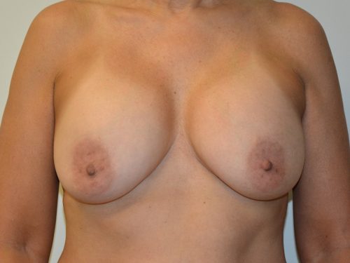 Breast Implant Removal Before Patient 1