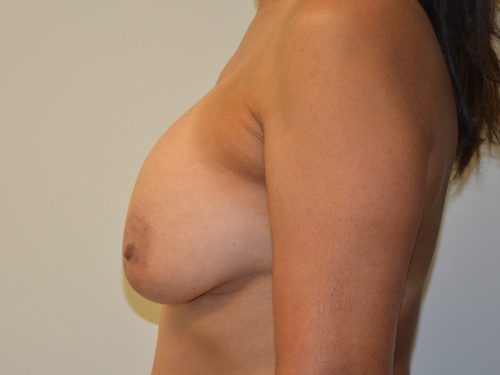 Breast Lift Before Patient 3