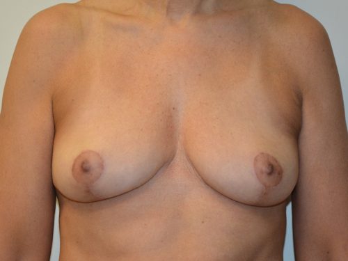 Breast Implant Removal After Patient 1