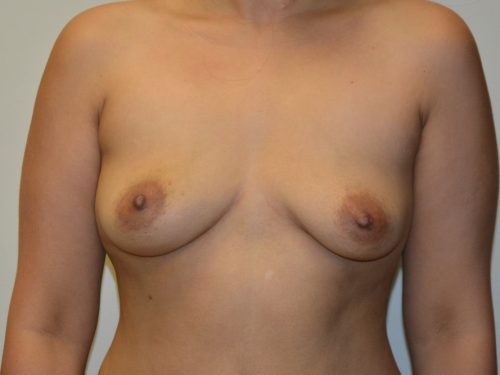 Breast Implant Removal After Patient 1