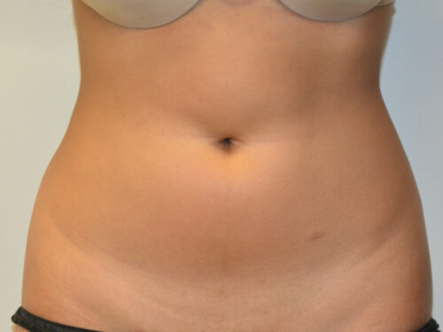 Liposuction Before Patient 1