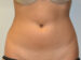 Liposuction Before Patient Thumbnail 1