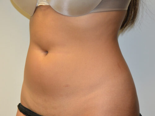 Liposuction Before Patient 2