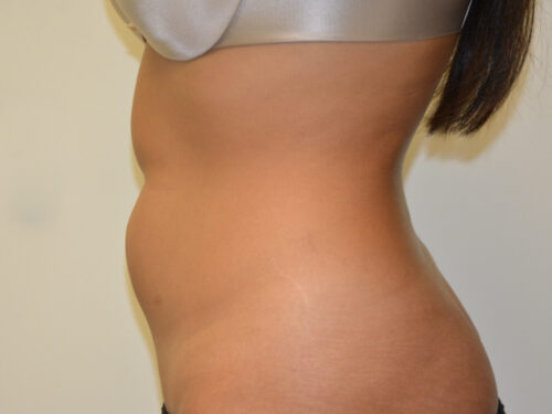 Liposuction Before Patient 3