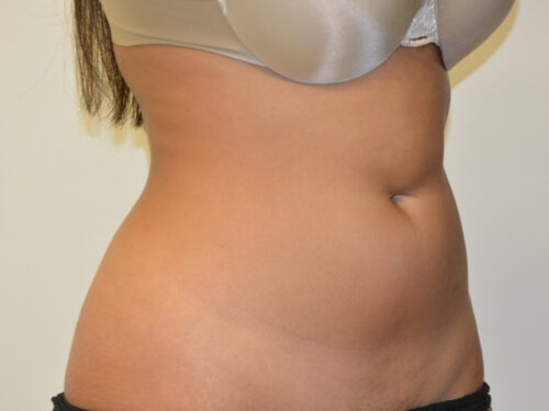 Liposuction Before Patient 4