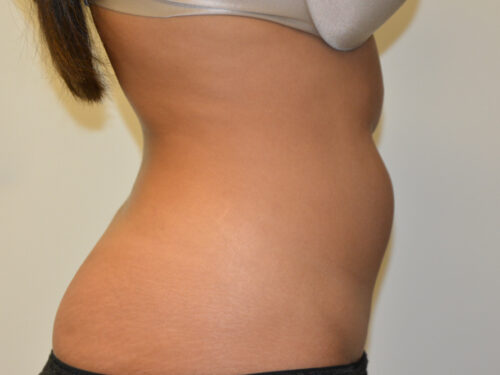 Liposuction Before Patient 5