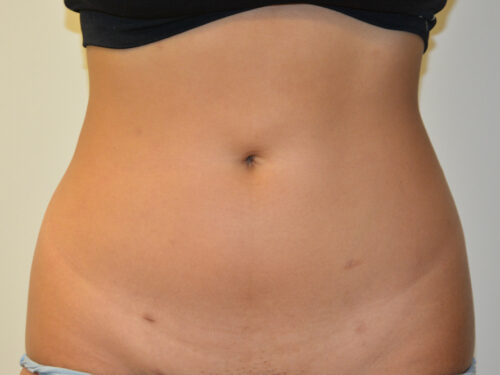 Liposuction After Patient 1