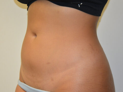 Liposuction After Patient 2