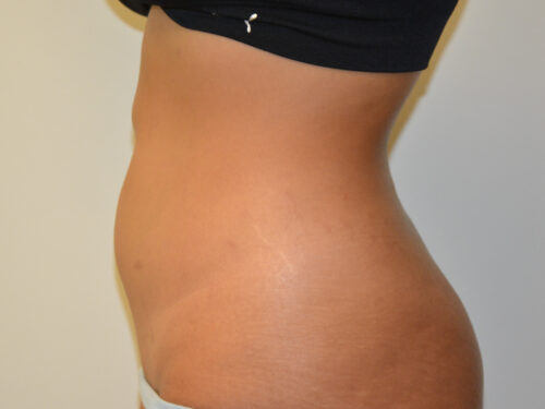 Liposuction After Patient 3