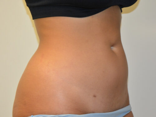 Liposuction After Patient 4