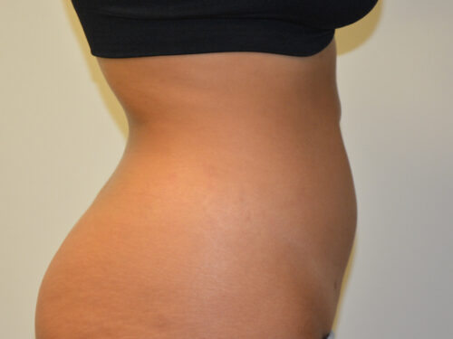 Liposuction After Patient 5