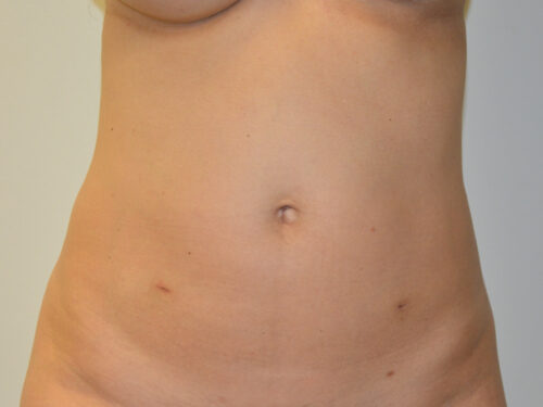 Mini Tummy Tuck Before Patient 1