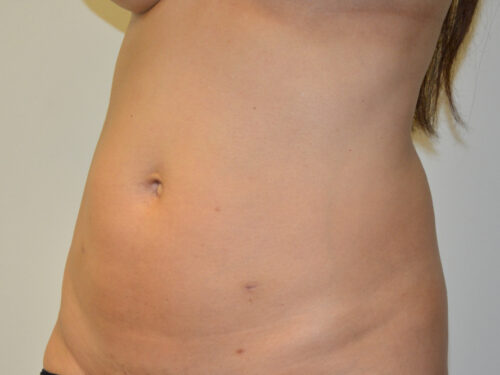 Mini Tummy Tuck Before Patient 2