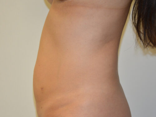 Mini Tummy Tuck Before Patient 3