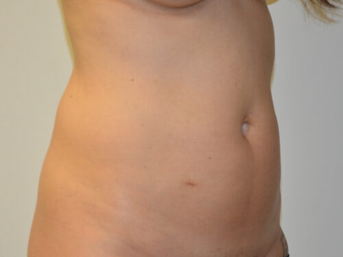 Mini Tummy Tuck Before Patient 4