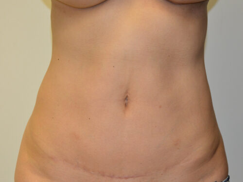 Mini Tummy Tuck After Patient 1