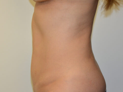 Mini Tummy Tuck After Patient 3