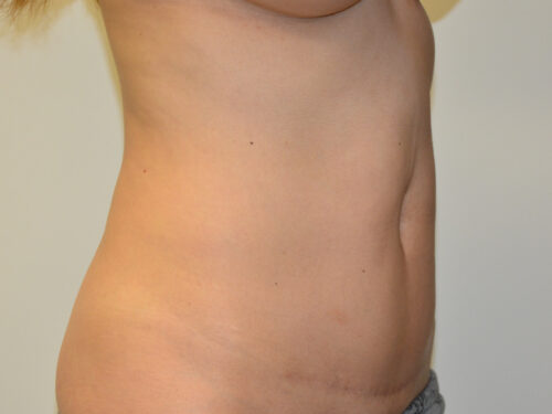 Mini Tummy Tuck After Patient 4