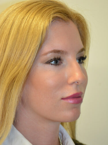 Rhinoplasty Before Patient 2