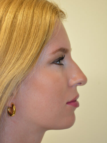 Rhinoplasty Before Patient 1