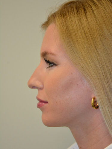 Rhinoplasty Before Patient 3