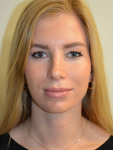 Rhinoplasty After Patient 5