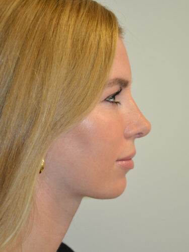 Rhinoplasty After Patient 1